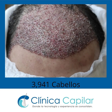 Slider image (6) Clinica Capilar